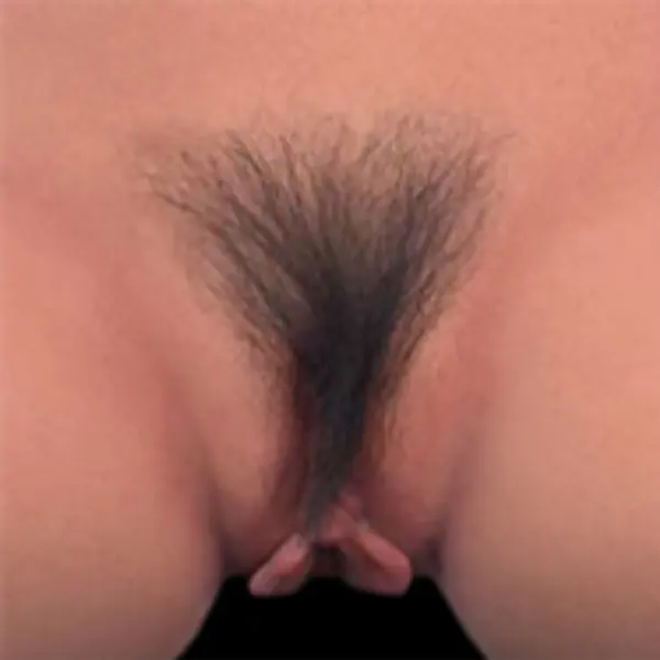 Pelo púbico implantado